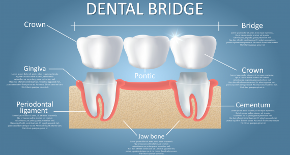 Things to be aware of Dental Bridges and Crowns