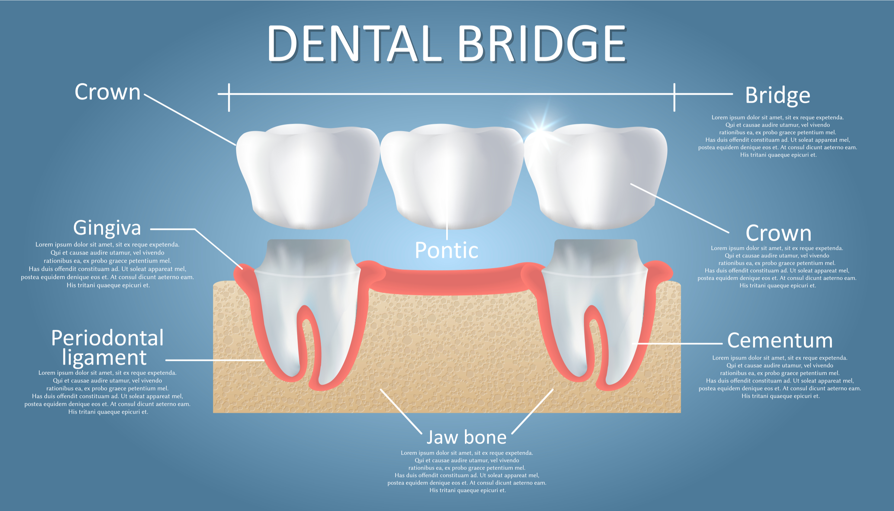 Things to be aware of Dental Bridges and Crowns